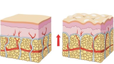 Photo of Методы борьбы с целлюлитом