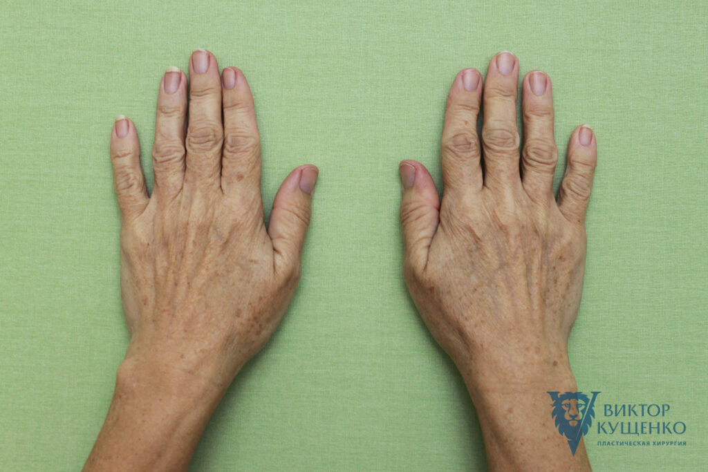 Фото 3 — Липофилинг: восстановление объемов