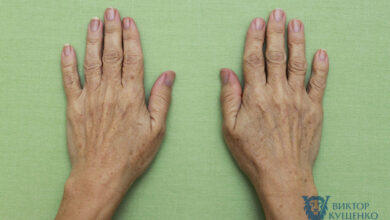 Photo of Липофилинг: восстановление объемов