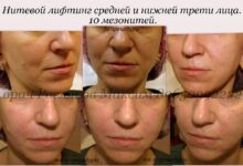 Photo of Мезонити: инъекции молодости