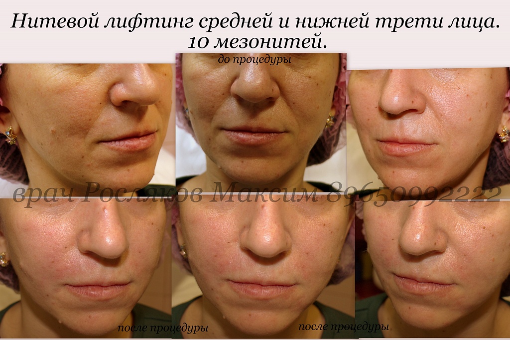 Фото 31 — Мезонити: инъекции молодости