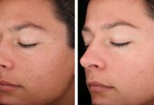 Photo of Химический пилинг: обновление кожи