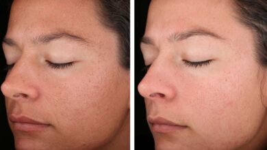 Photo of Химический пилинг: обновление кожи