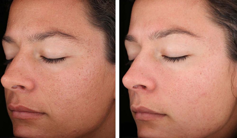 Фото 2 — Химический пилинг: обновление кожи