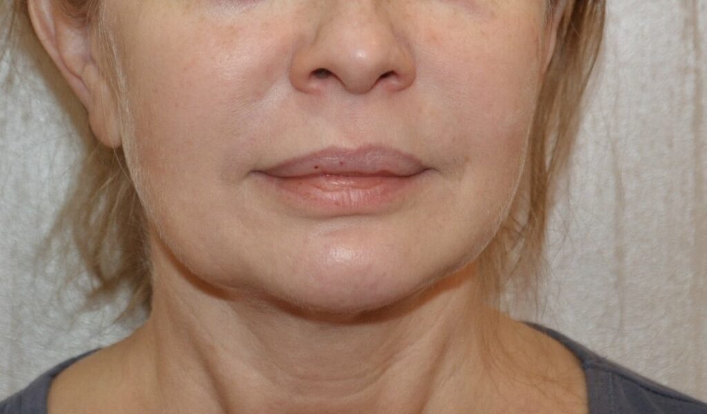 Фото 33 — Подтяжка лица нитями: безоперационный лифтинг