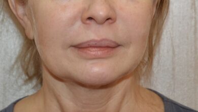 Photo of Подтяжка лица нитями: безоперационный лифтинг