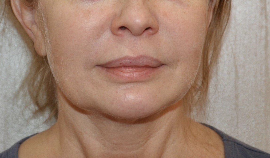 Фото 33 — Подтяжка лица нитями: безоперационный лифтинг