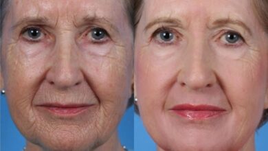 Photo of Плазмолифтинг: восстановление кожи