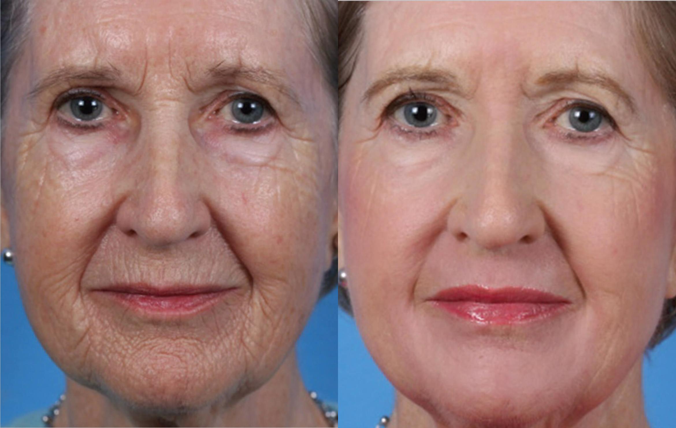 Фото 11 — Плазмолифтинг: восстановление кожи