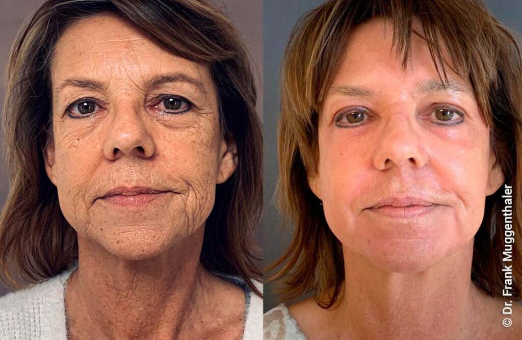 Фото 6 — Пилинг фрутовый: натуральный уход