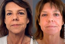 Photo of Пилинг фрутовый: натуральный уход