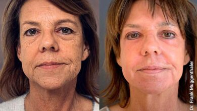 Photo of Пилинг фрутовый: натуральный уход