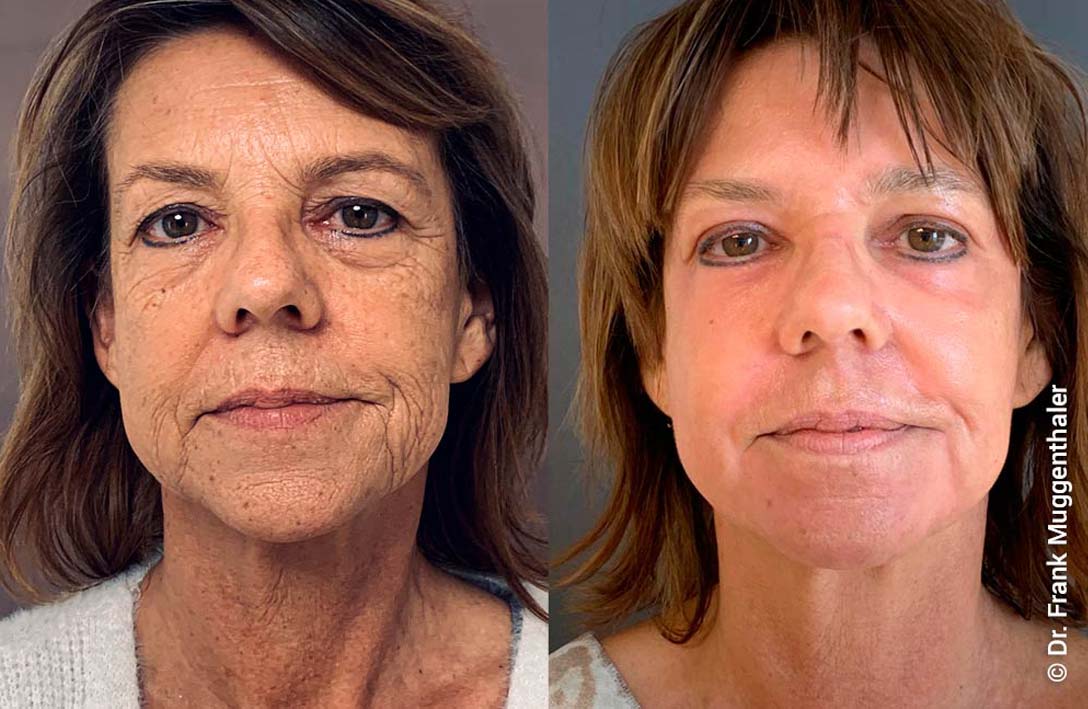 Фото 6 — Пилинг фрутовый: натуральный уход